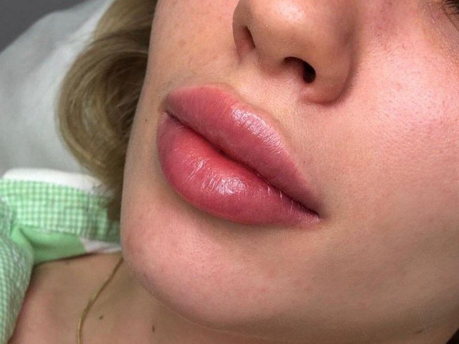 Фото красивых губ после увеличения